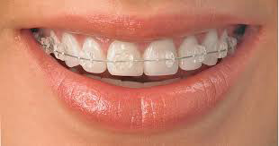 clear braces bands