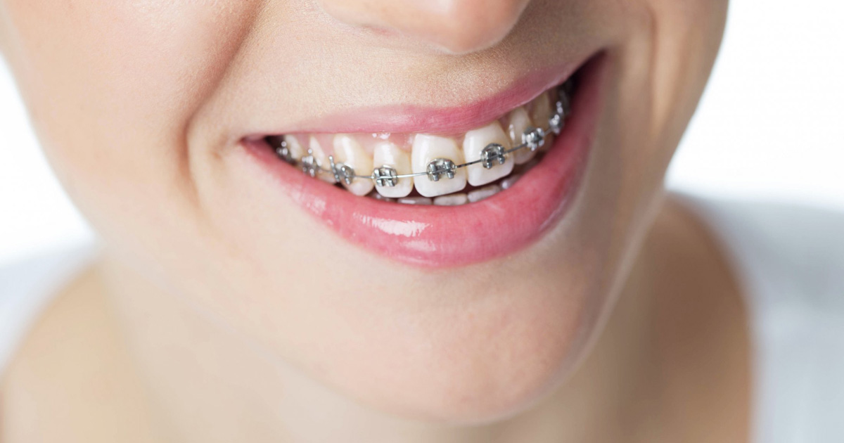 Traditional Metal Braces | FUNtastic Dental \u0026 Orthodontics